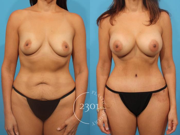 Before & After Breast Augmentation Case 828 Front View in Fort Worth, Plano, & Frisco, Texas