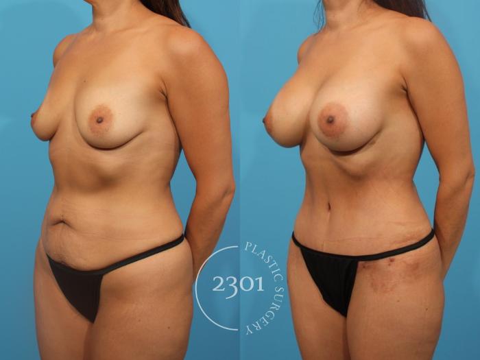 Before & After Tummy Tuck Case 828 Left Oblique View in Fort Worth, Plano, & Frisco, Texas