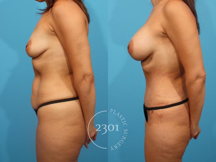 Before & After Breast Augmentation Case 828 Left Side View in Fort Worth, Plano, & Frisco, Texas