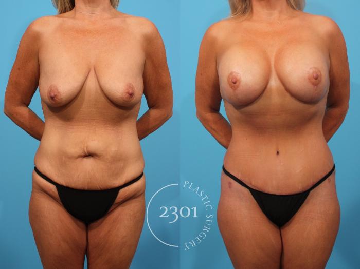 Before & After Tummy Tuck Case 833 Front View in Fort Worth, Plano, & Frisco, Texas