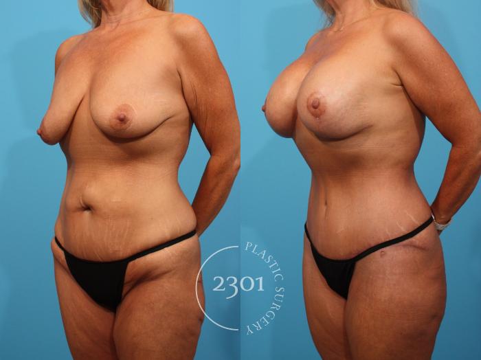 Before & After Mastopexy & Augmentation Case 833 Left Oblique View in Fort Worth, Plano, & Frisco, Texas