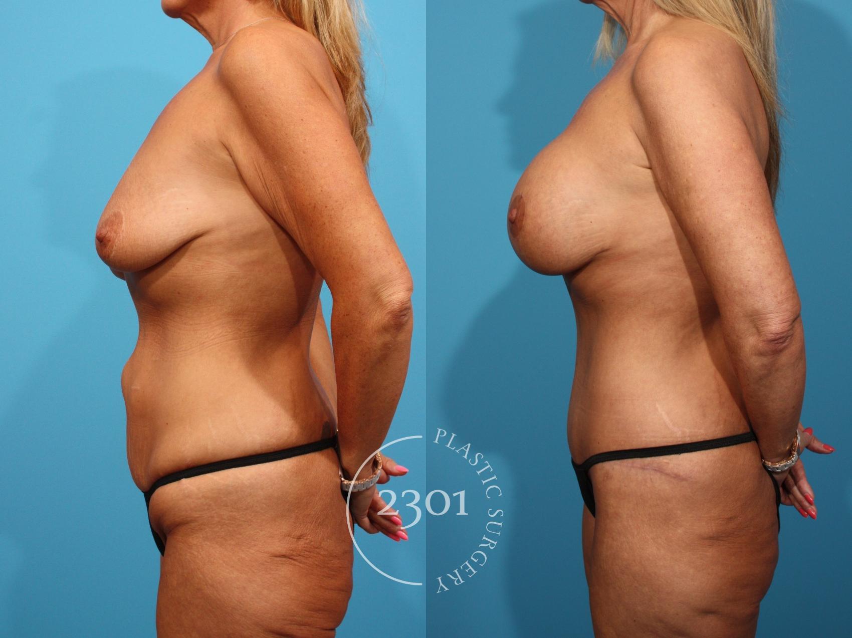 Before & After Mommy Makeover Case 833 Left Side View in Fort Worth, Plano, & Frisco, Texas