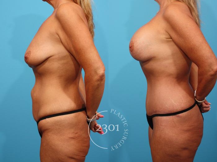 Before & After Mastopexy & Augmentation Case 833 Left Side View in Fort Worth, Plano, & Frisco, Texas