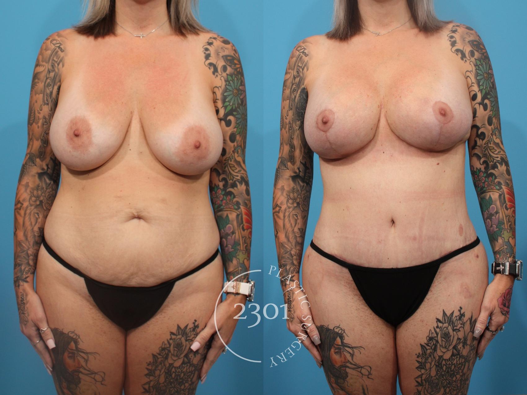 Before & After Breast Lift (Mastopexy) Case 839 Front View in Fort Worth, Plano, & Frisco, Texas