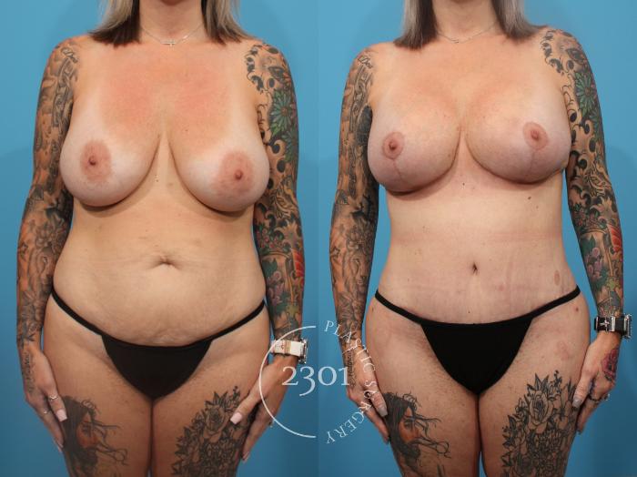 Before & After Breast Lift (Mastopexy) Case 839 Front View in Fort Worth, Plano, & Frisco, Texas