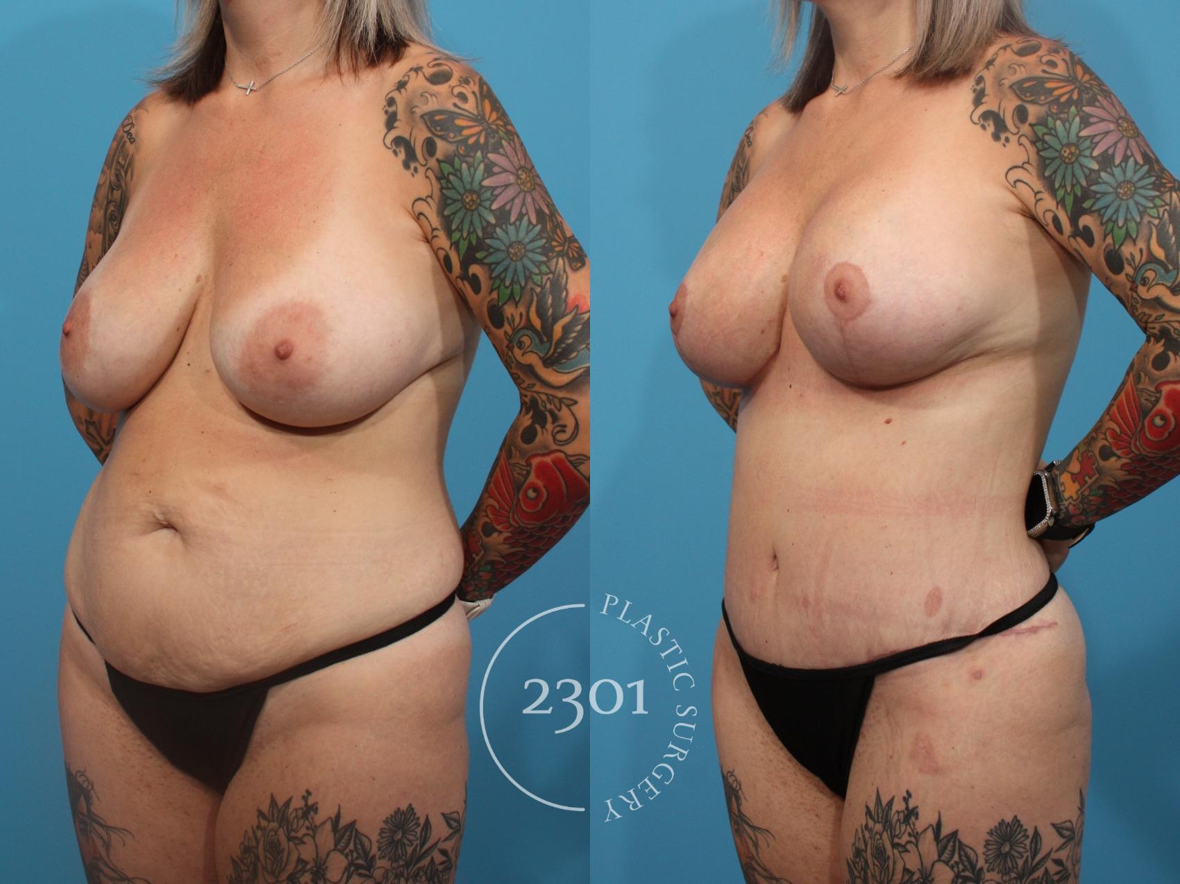 Before & After Tummy Tuck Case 839 Left Oblique View in Fort Worth, Plano, & Frisco, Texas