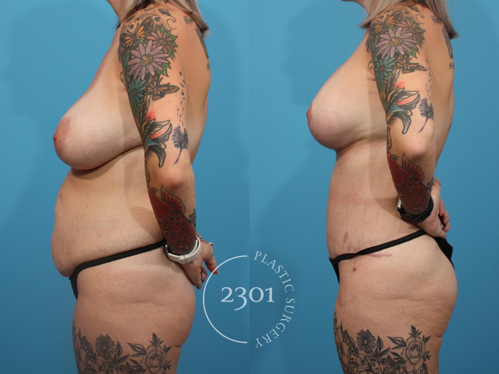 Before & After Tummy Tuck Case 839 Left Side View in Fort Worth, Plano, & Frisco, Texas