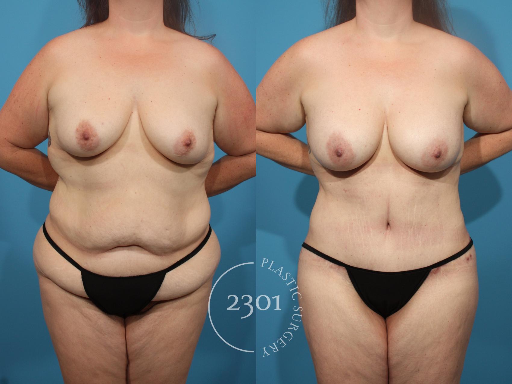 Before & After Breast Augmentation Case 845 Front View in Fort Worth, Plano, & Frisco, Texas