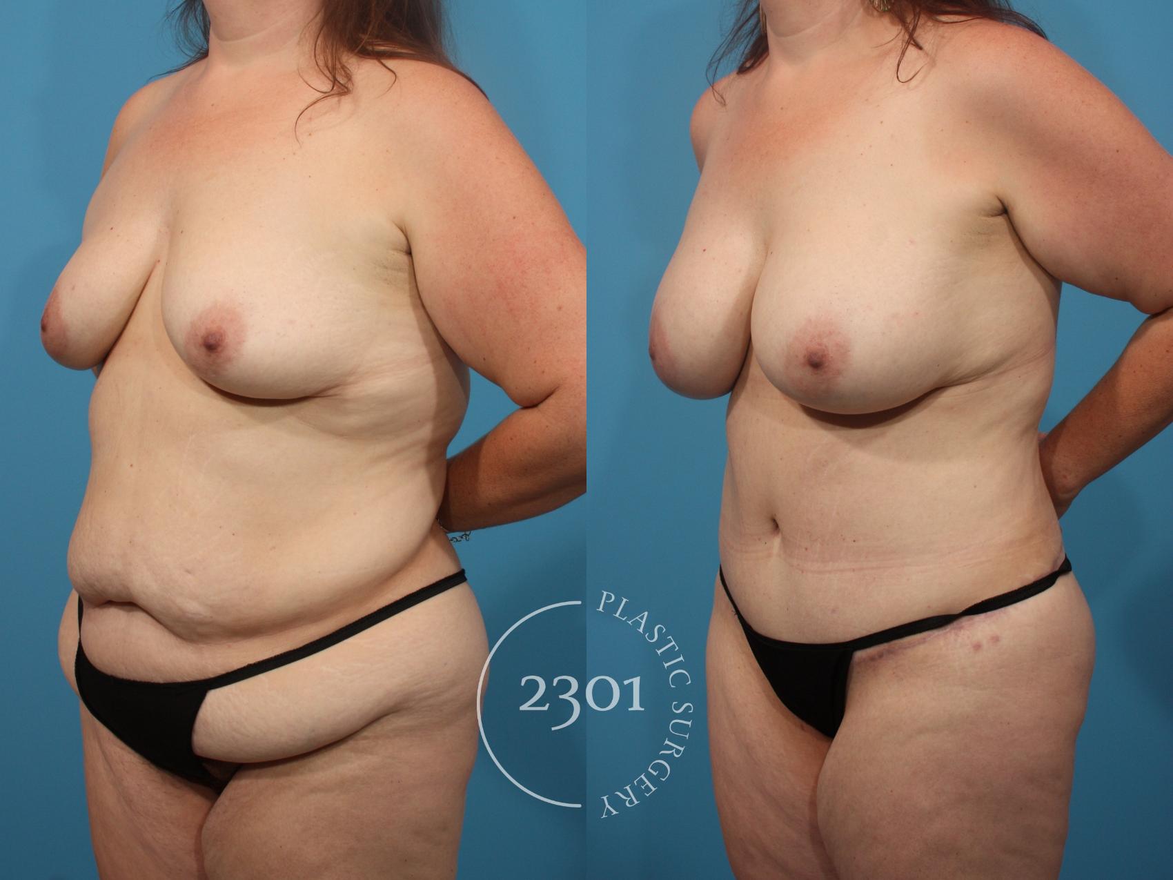 Before & After Tummy Tuck Case 845 Left Oblique View in Fort Worth, Plano, & Frisco, Texas
