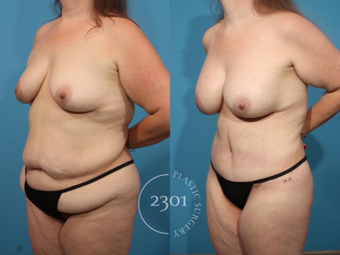 Before & After Mommy Makeover Case 845 Left Oblique View in Fort Worth, Plano, & Frisco, Texas