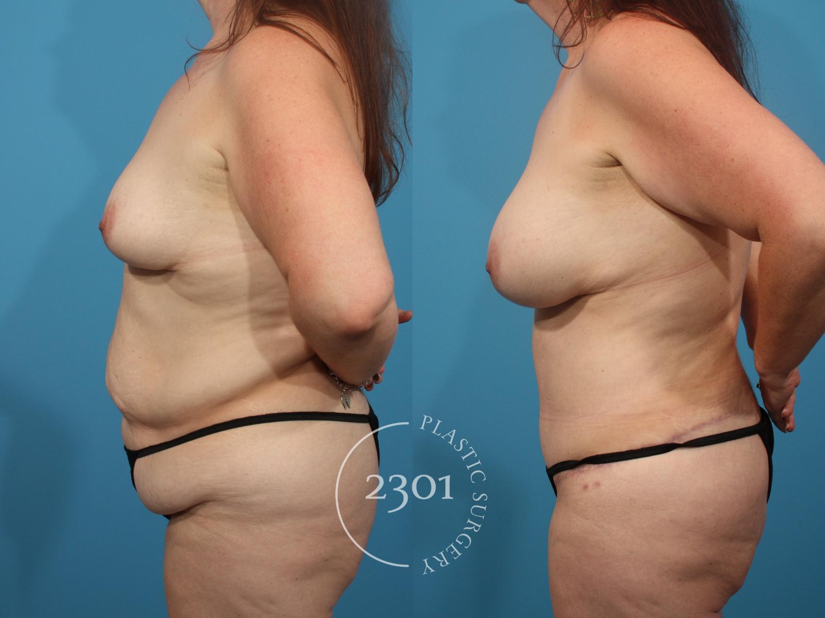 Before & After Tummy Tuck Case 845 Left Side View in Fort Worth, Plano, & Frisco, Texas