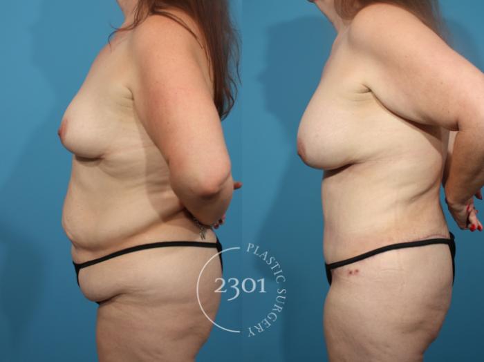 Before & After Breast Augmentation Case 845 Left Side View in Fort Worth, Plano, & Frisco, Texas