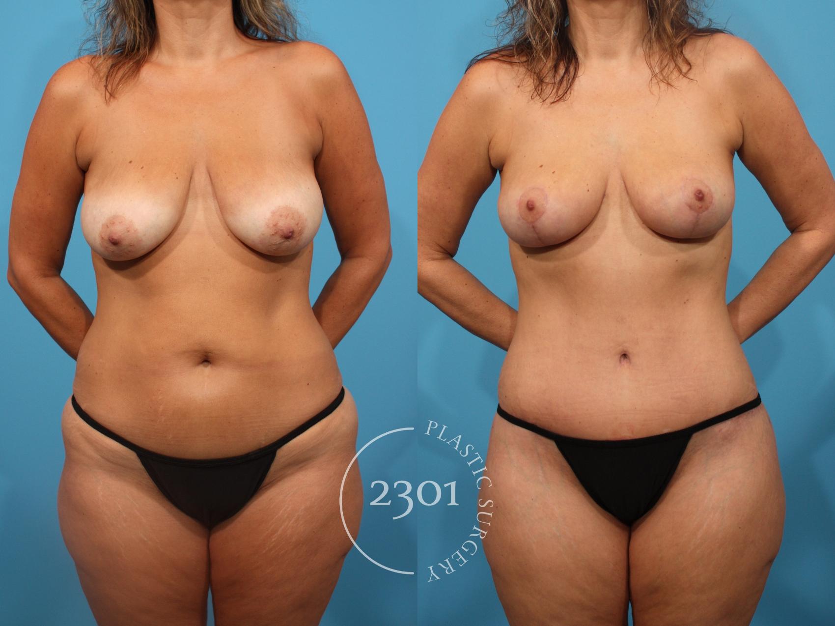 Before & After Breast Lift (Mastopexy) Case 846 Front View in Fort Worth, Plano, & Frisco, Texas