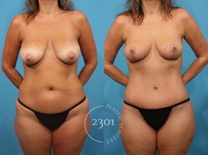 Before & After Tummy Tuck Case 846 Front View in Fort Worth, Plano, & Frisco, Texas