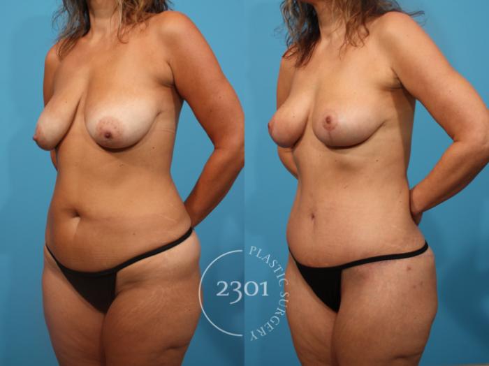 Before & After Tummy Tuck Case 846 Left Oblique View in Fort Worth, Plano, & Frisco, Texas