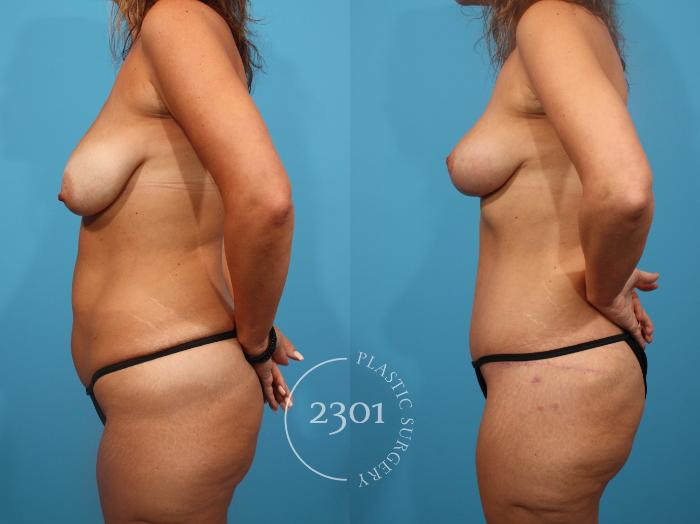 Before & After Tummy Tuck Case 846 Left Side View in Fort Worth, Plano, & Frisco, Texas