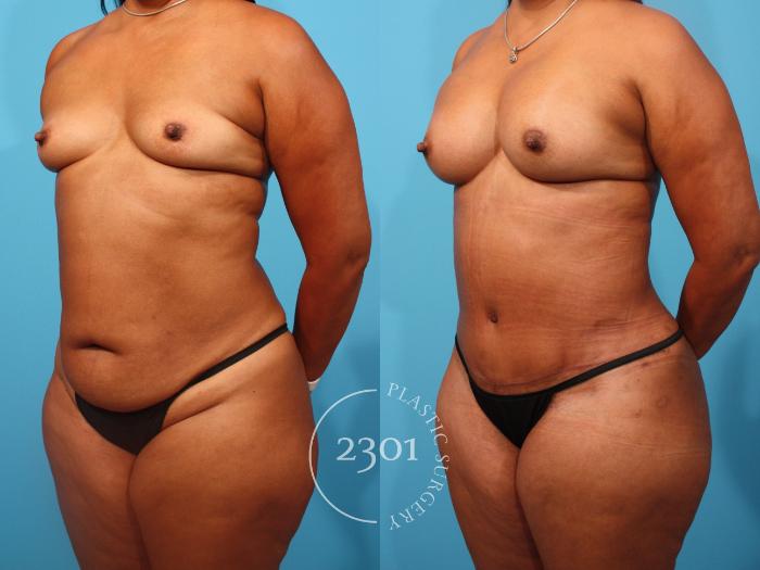 Before & After Mommy Makeover Case 848 Left Oblique View in Fort Worth, Plano, & Frisco, Texas