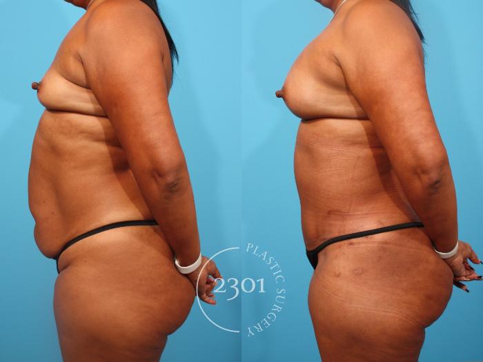 Before & After Mommy Makeover Case 848 Left Side View in Fort Worth, Plano, & Frisco, Texas