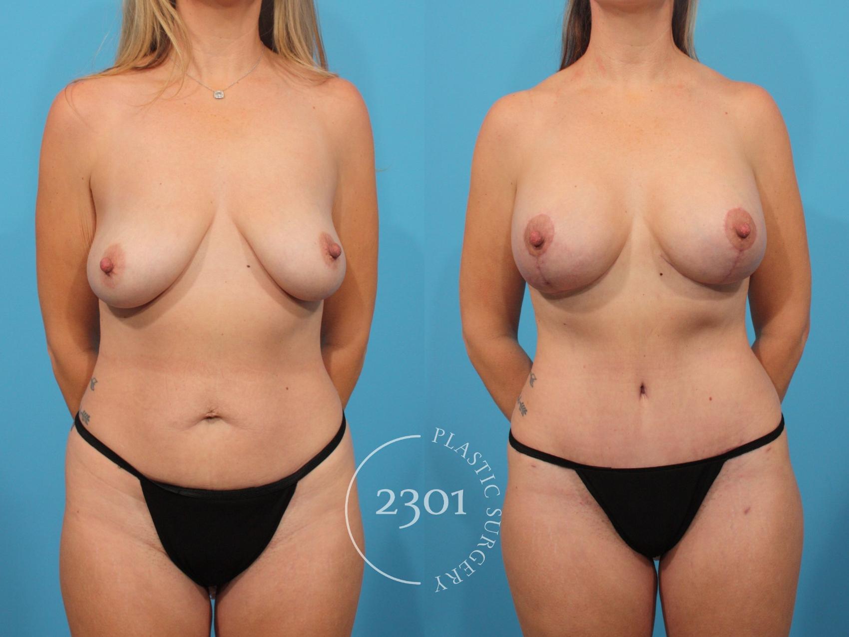 Before & After Mastopexy & Augmentation Case 859 Front View in Fort Worth, Plano, & Frisco, Texas