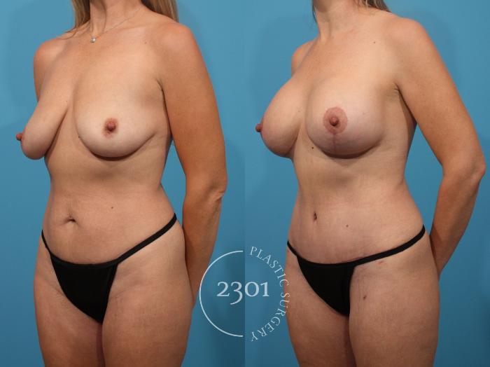 Before & After Mommy Makeover Case 859 Left Oblique View in Fort Worth, Plano, & Frisco, Texas