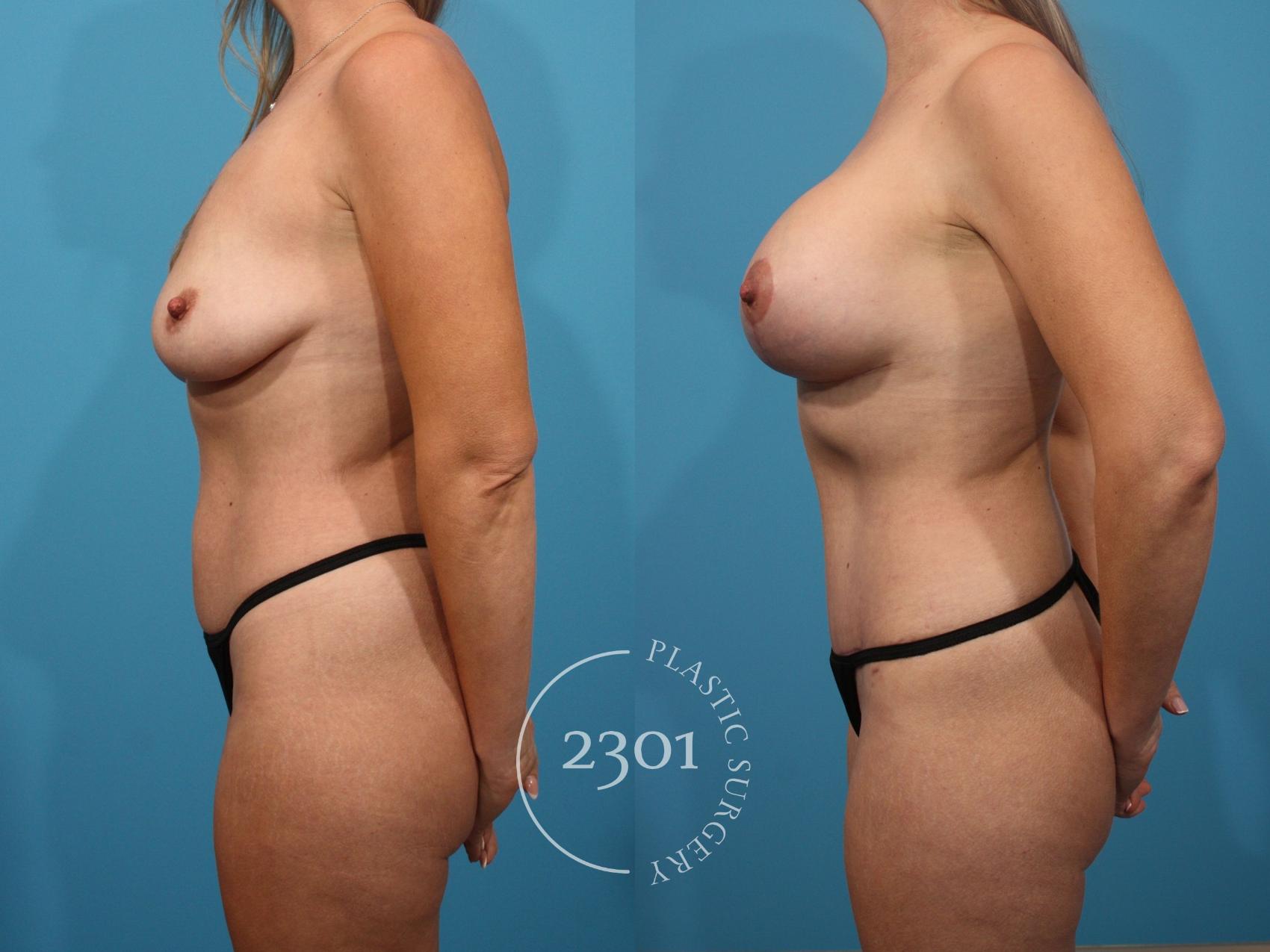 Before & After Mastopexy & Augmentation Case 859 Left Side View in Fort Worth, Plano, & Frisco, Texas