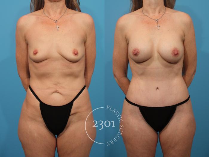 Before & After Mommy Makeover Case 867 Front View in Fort Worth, Plano, & Frisco, Texas