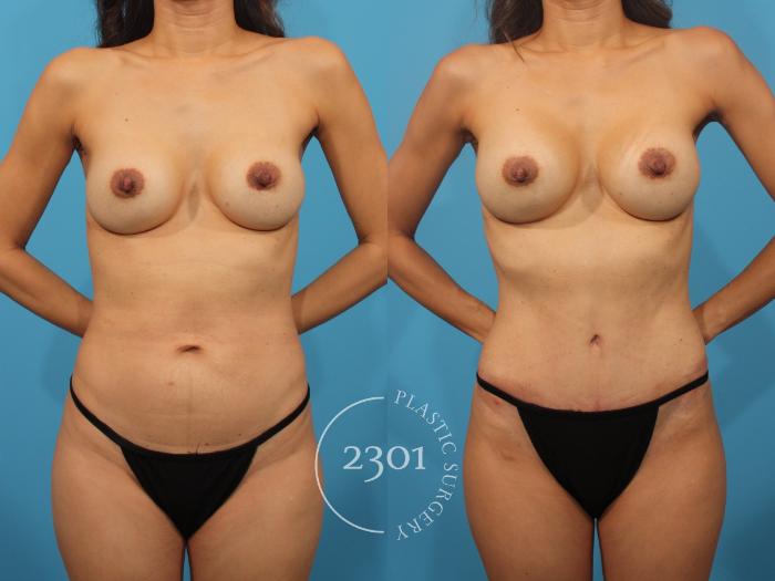 Before & After Mommy Makeover Case 881 Front View in Fort Worth, Plano, & Frisco, Texas