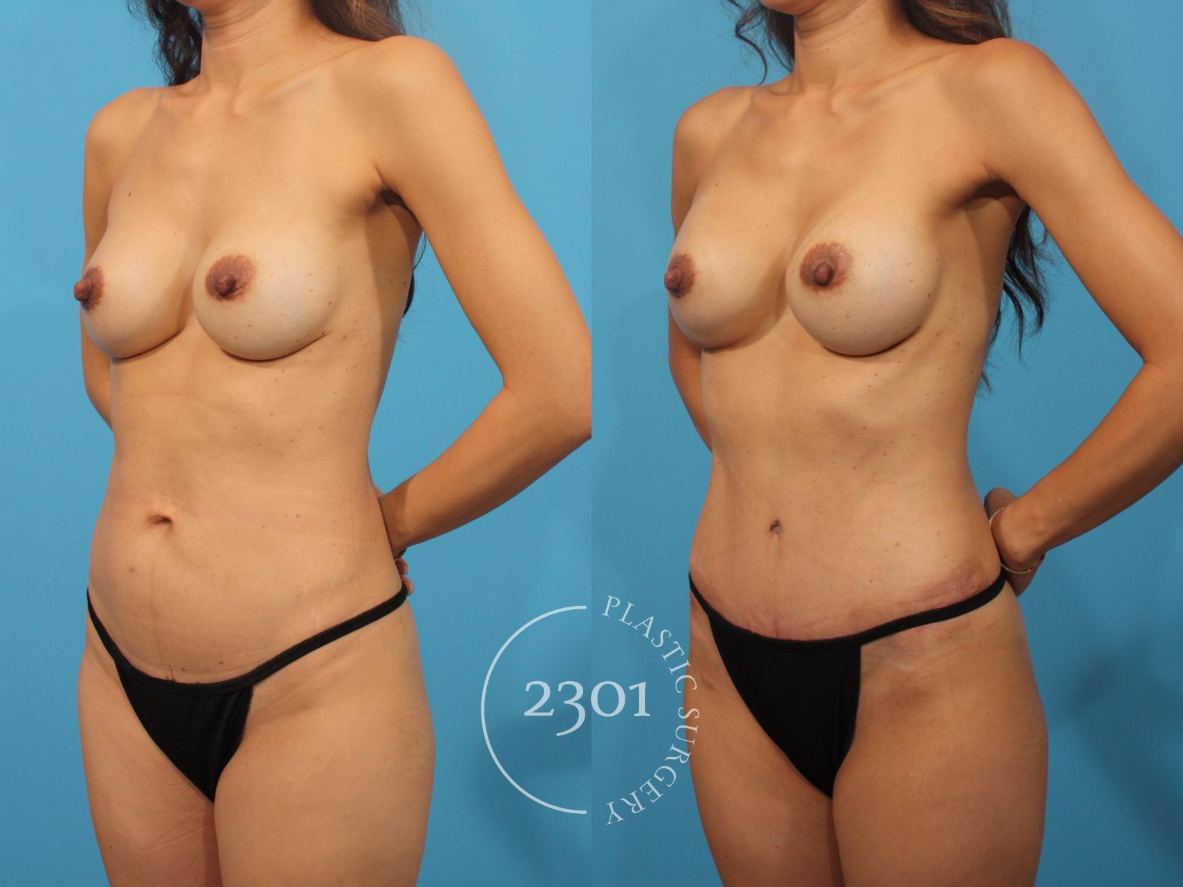 Before & After Silicone Implants Case 881 Left Oblique View in Fort Worth, Plano, & Frisco, Texas