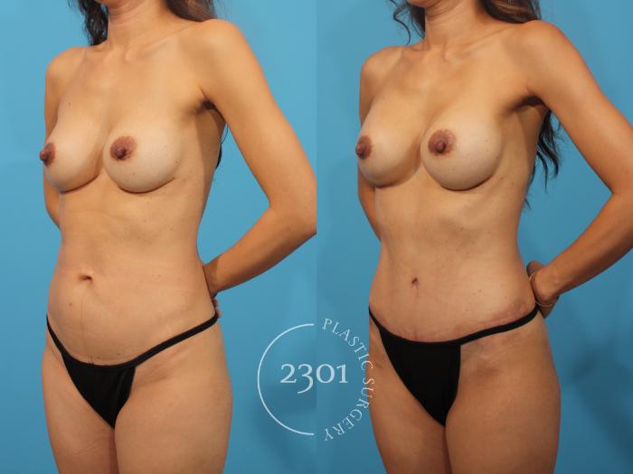 Before & After Mommy Makeover Case 881 Left Oblique View in Fort Worth, Plano, & Frisco, Texas