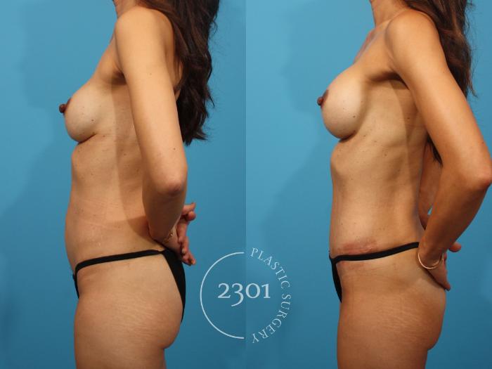 Before & After Mommy Makeover Case 881 Left Side View in Fort Worth, Plano, & Frisco, Texas