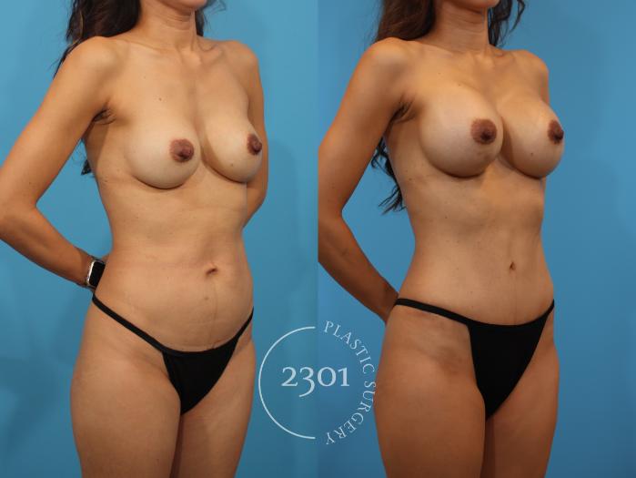 Before & After Mommy Makeover Case 881 Right Oblique View in Fort Worth, Plano, & Frisco, Texas