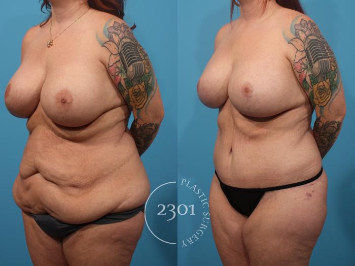 Before & After Mommy Makeover Case 885 Left Oblique View in Fort Worth, Plano, & Frisco, Texas