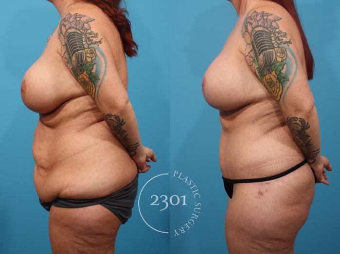 Before & After Mommy Makeover Case 885 Left Side View in Fort Worth, Plano, & Frisco, Texas