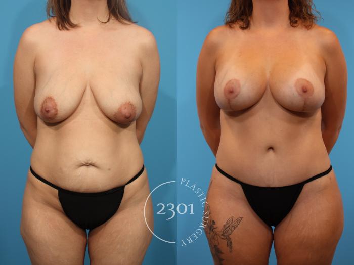Before & After Mommy Makeover Case 897 Front View in Fort Worth, Plano, & Frisco, Texas