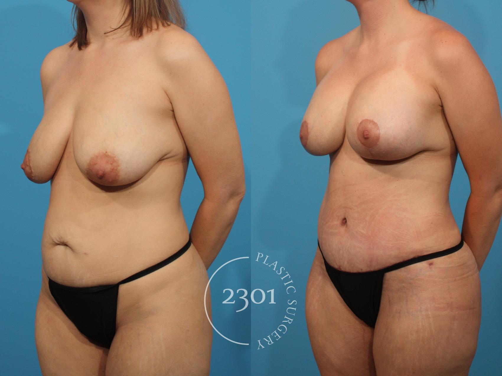Before & After Mommy Makeover Case 897 Left Oblique View in Fort Worth, Plano, & Frisco, Texas