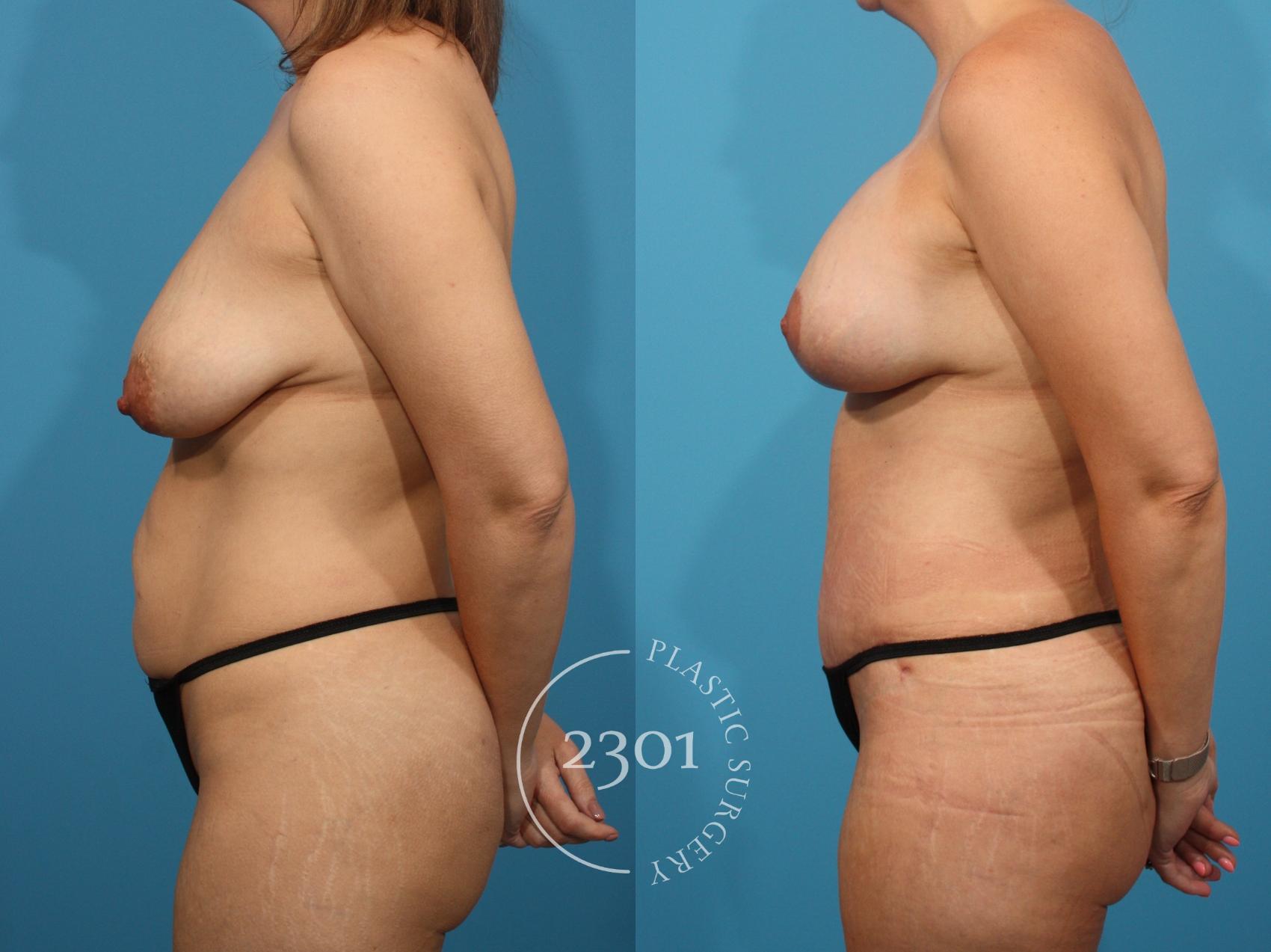 Before & After Mommy Makeover Case 897 Left Side View in Fort Worth, Plano, & Frisco, Texas
