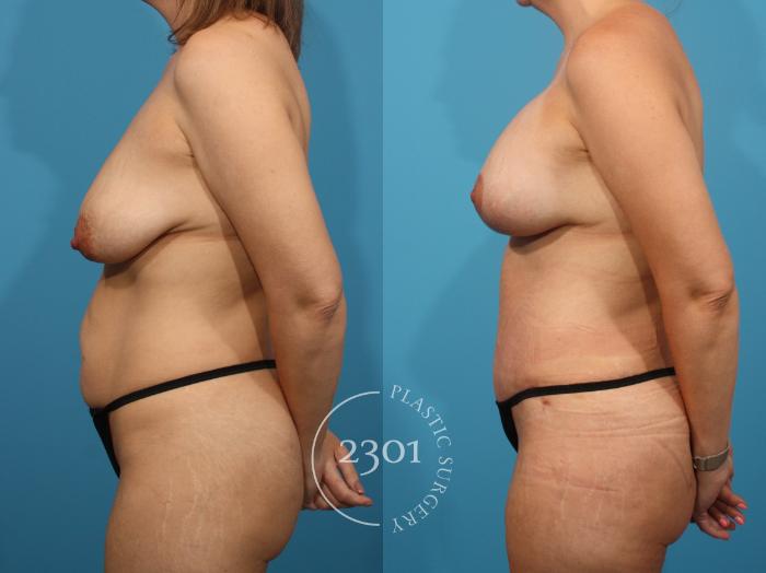 Before & After Mommy Makeover Case 897 Left Side View in Fort Worth, Plano, & Frisco, Texas