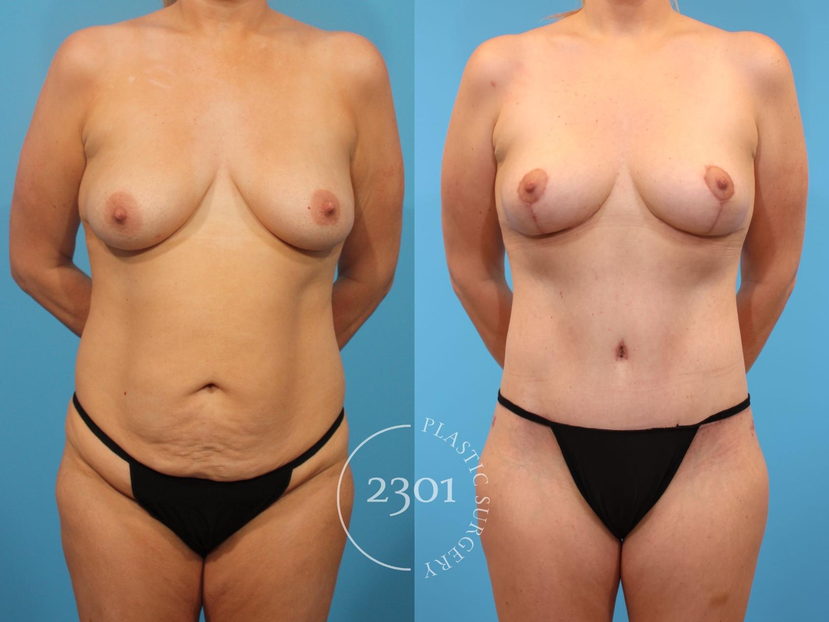 Before & After Breast Lift (Mastopexy) Case 900 Front View in Fort Worth, Plano, & Frisco, Texas
