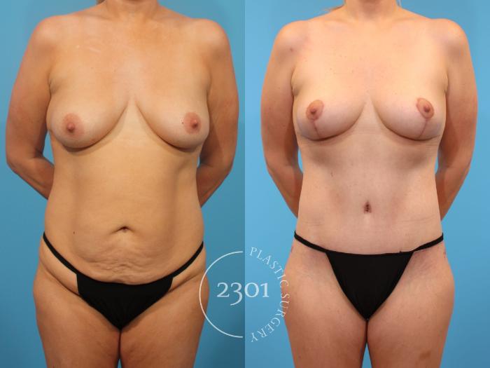 Before & After Breast Lift (Mastopexy) Case 900 Front View in Fort Worth, Plano, & Frisco, Texas