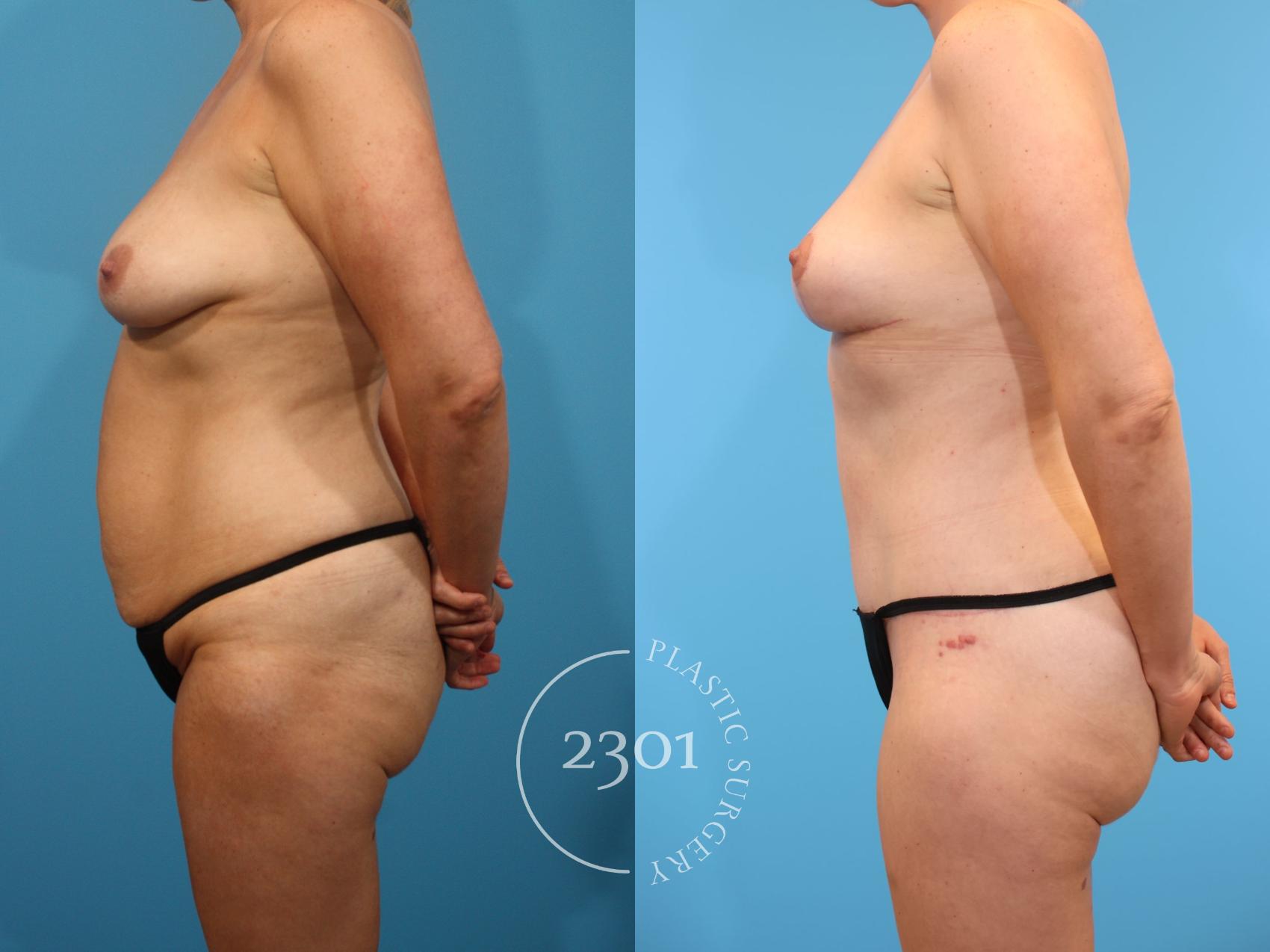 Before & After Breast Lift (Mastopexy) Case 900 Left Side View in Fort Worth, Plano, & Frisco, Texas