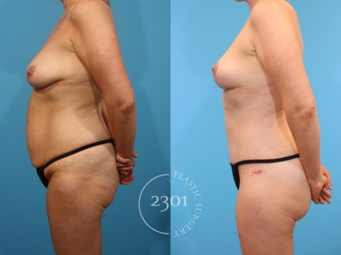 Before & After Breast Lift (Mastopexy) Case 900 Left Side View in Fort Worth, Plano, & Frisco, Texas