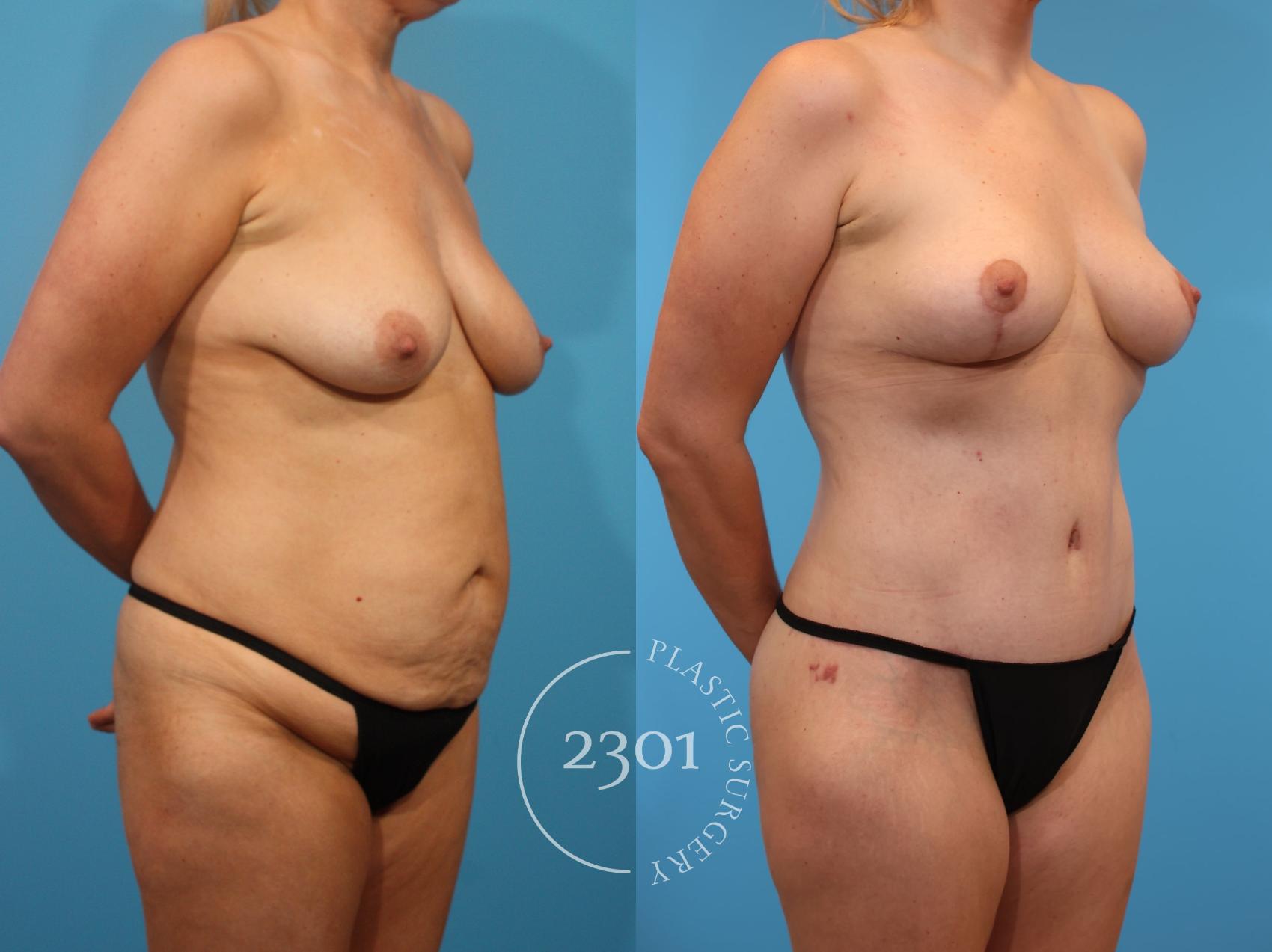 Before & After Breast Lift (Mastopexy) Case 900 Right Oblique View in Fort Worth, Plano, & Frisco, Texas