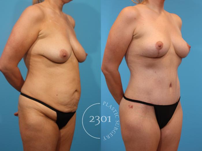 Before & After Breast Lift (Mastopexy) Case 900 Right Oblique View in Fort Worth, Plano, & Frisco, Texas