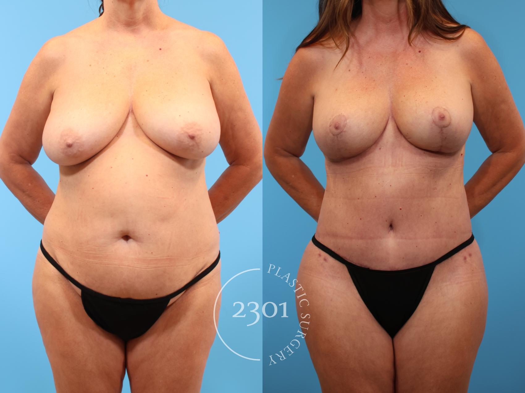 Before & After Mommy Makeover Case 908 Front View in Fort Worth, Plano, & Frisco, Texas