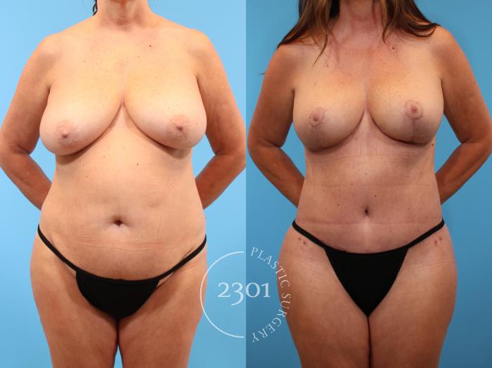 Before & After Mommy Makeover Case 908 Front View in Fort Worth, Plano, & Frisco, Texas