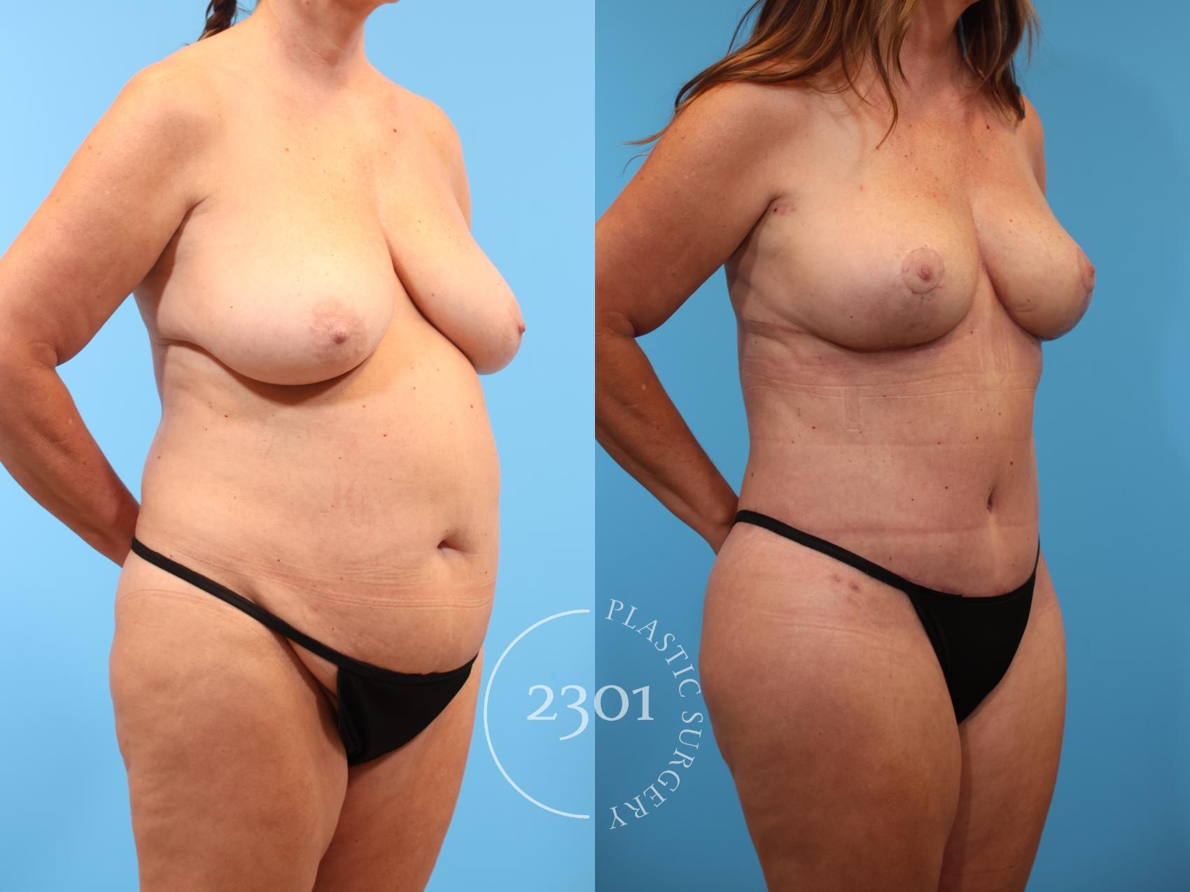 Before & After Mommy Makeover Case 908 Right Oblique View in Fort Worth, Plano, & Frisco, Texas