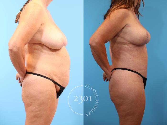 Before & After Mommy Makeover Case 908 Right Side View in Fort Worth, Plano, & Frisco, Texas