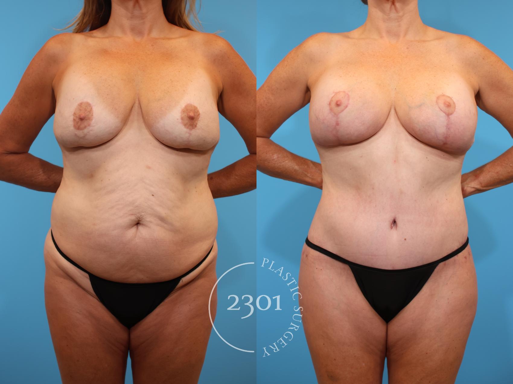 Before & After Mommy Makeover Case 910 Front View in Fort Worth, Plano, & Frisco, Texas