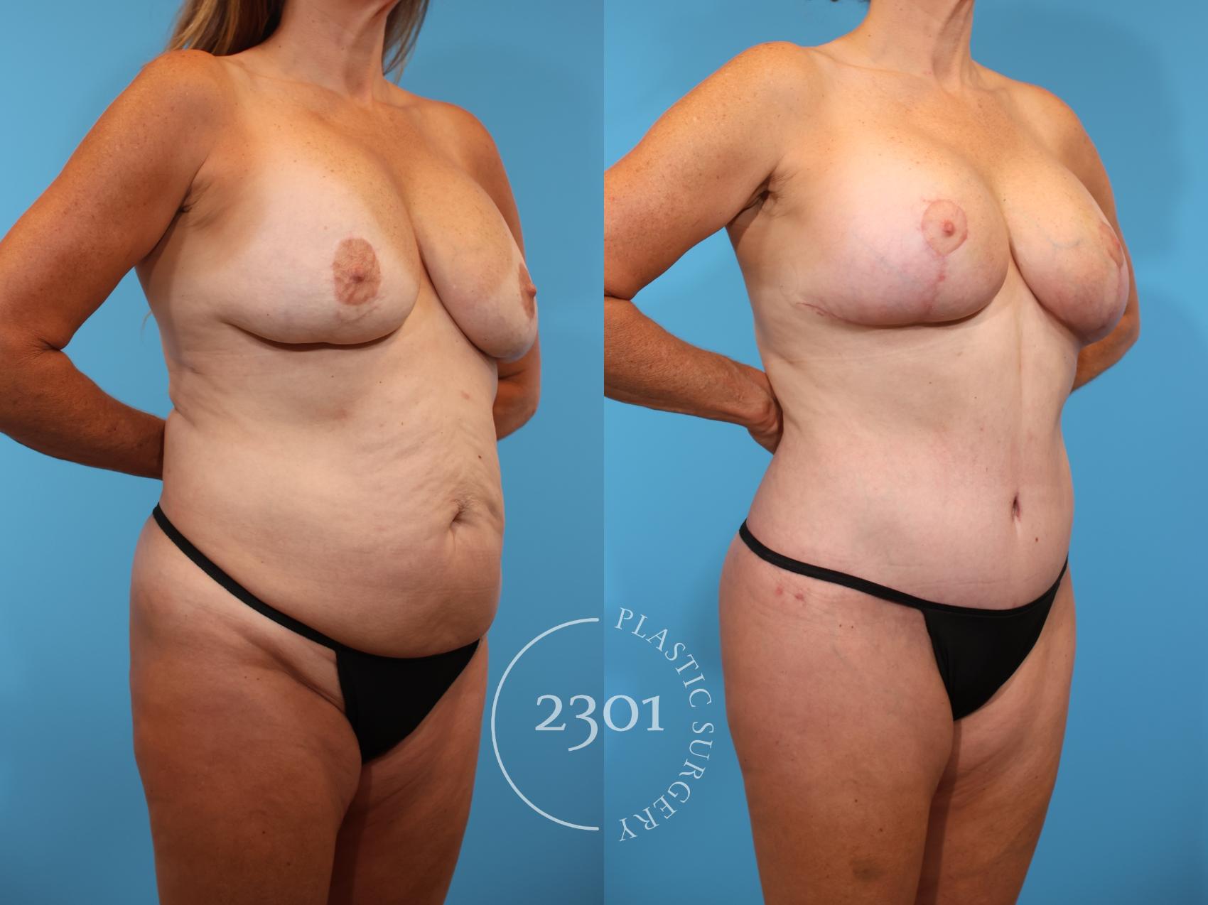 Before & After Mommy Makeover Case 910 Right Oblique View in Fort Worth, Plano, & Frisco, Texas