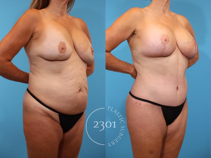 Before & After Mommy Makeover Case 910 Right Oblique View in Fort Worth, Plano, & Frisco, Texas